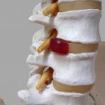 椎間板ヘルニアは腰痛の原因になるのか？