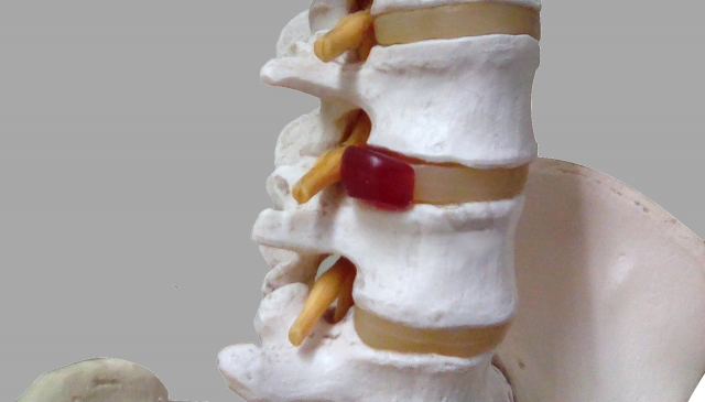 椎間板ヘルニアは腰痛の原因になるのか？
